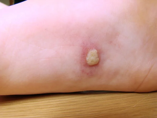 Herpis Baby Leg Disease Characteristic Close Photo Rash — Stock Photo, Image