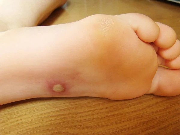 Herpis Baby Leg Disease Characteristic Close Photo Rash — Stock Photo, Image