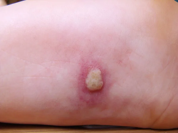 婴儿腿上的疱疹是一种带有特写镜头皮疹的疾病 — 图库照片