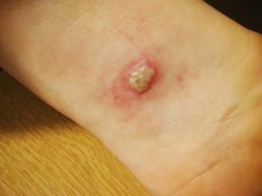 Bebeğin bacağındaki Herpis, yakın plan fotoğraf kızarıklığı olan bir hastalıktır.