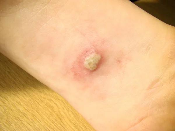 赤ん坊の足の上のヘルペスは 特徴的なクローズアップ写真発疹の病気です — ストック写真