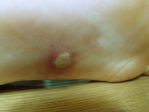 Herpis Baby Leg Disease Characteristic Close Photo Rash — Stock Photo, Image