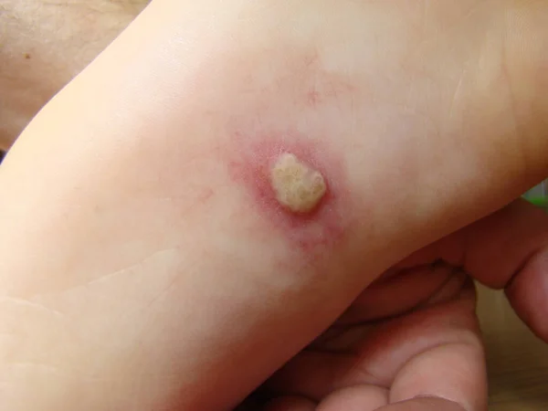 赤ん坊の足の上のヘルペスは 特徴的なクローズアップ写真発疹の病気です — ストック写真
