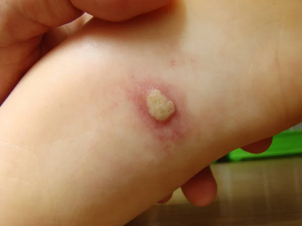 Herpis Στο Πόδι Του Μωρού Είναι Μια Ασθένεια Ένα Χαρακτηριστικό — Φωτογραφία Αρχείου
