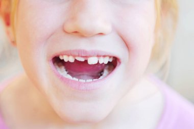 Çarpık dişli çocuk. Kız diastema dişlerini gösteriyor..