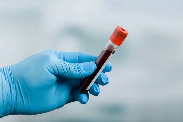 Después de tomar sangre: mano con guantes y sonda de sangre — Foto de Stock