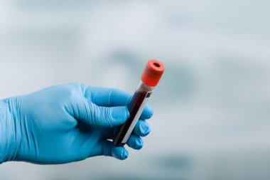 tıbbi eldivenli elini kan sonda tutuyor