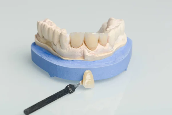 Comprobación de verneer de dentadura postiza en laboratorio dental — Foto de Stock