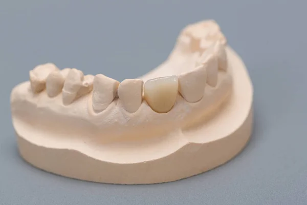 Impresión Dental Con Dentición Artificial Laboratorio Dental Listo Para Uso — Foto de Stock