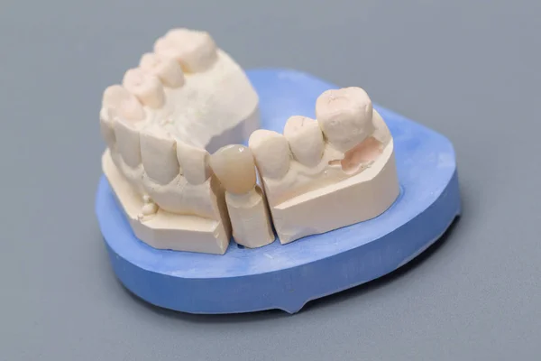Impronta Dentale Con Dentizione Artificiale Laboratorio Odontoiatrico Pronto All Uso — Foto Stock