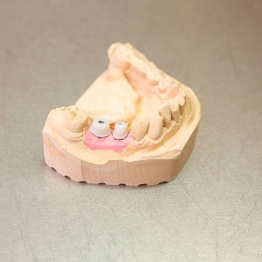 Dental laboratuvardaki suni dentiyle Dental baskı, kullanıma hazır