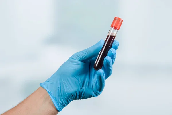 Kéz Kék Kesztyű Kezében Egy Vérvizsgálati Cső Előtt Egy Laborszobában — Stock Fotó