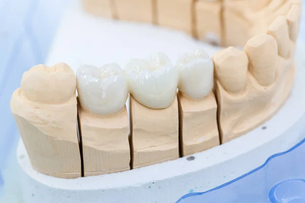 Bir diş laboratuarında yapay dişçiye sahip diş izi.