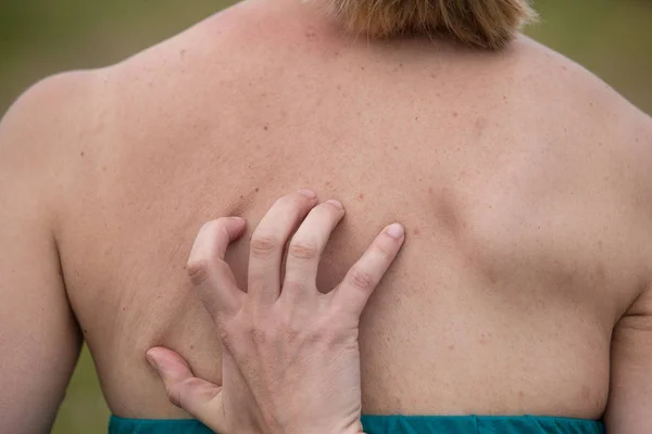 Women with skin pigmentation on back