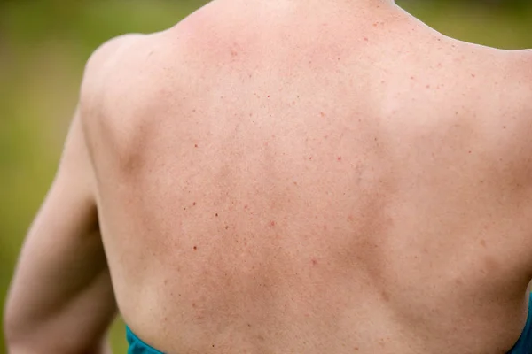 Women with skin pigmentation on back