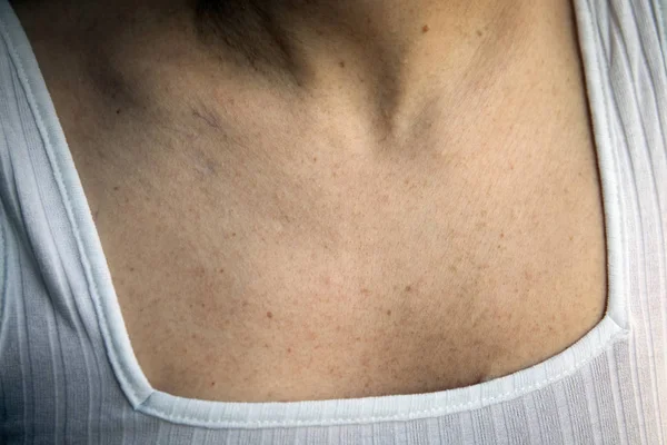 Женщины с пигментацией кожи и большим количеством родимых пятен — стоковое фото