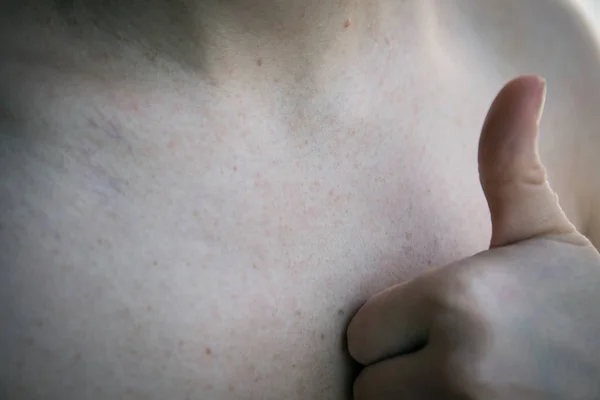 Femmes avec pigmentation de la peau et beaucoup de taches de naissance — Photo