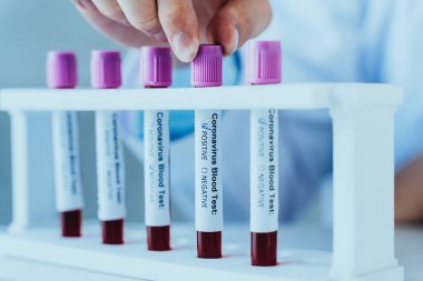 Erkek doktor elleri Coronavirus ya da Covid 19 numune testini pozitif değerler için tutuyor. Corona Virüsü - 2019-NCOV Salgın Solunum Hastalığı