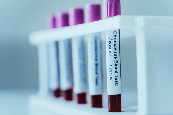 Blood test tubes in a row for laboratory blood analysis. Corona Virus laboratory testing patient blood samples. Positive Test indicated infected from Coronavirus or Covid 19