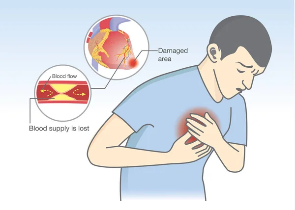 Cause de crise cardiaque symptômes de la circulation sanguine sont bloqués . — Image vectorielle