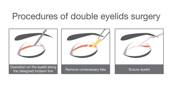 Procedimentos de cirurgia de pálpebras duplas . —  Vetores de Stock