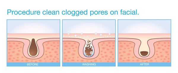 Procedimento limpo poros entupidos na face . — Vetor de Stock