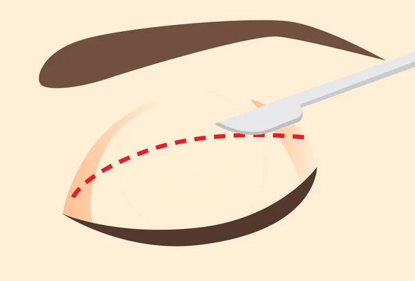 設計された切開線に沿ってまぶた上にナイフ. — ストックベクタ