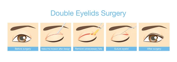 Çift göz kapakları cerrahi prosedürleri. — Stok Vektör