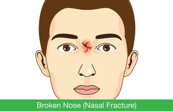 Broken nose on facial of man. — Stock Vector