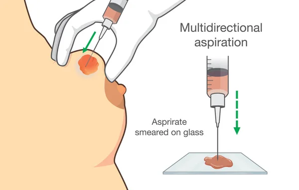 Drenagem de cisto de mama com agulha para encontrar câncer de mama . — Vetor de Stock