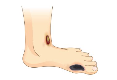 Diabetic Foot Pain and Ulcers. clipart