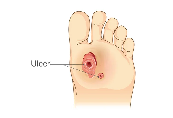 Úlceras cutáneas de pacientes diabéticos . — Vector de stock