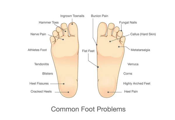 Häufige Fußprobleme. — Stockvektor