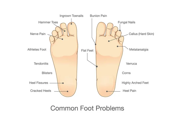 Problemas comunes en los pies . — Vector de stock