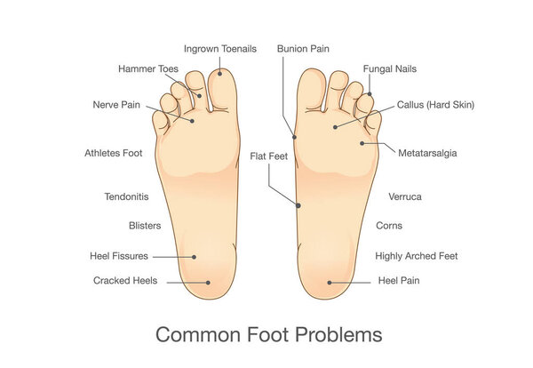 Common foot problems.