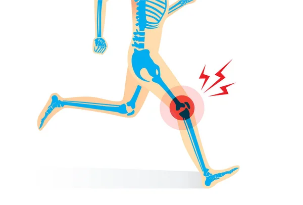Lésion traumatique de l'os du genou et de la jambe en courant — Image vectorielle