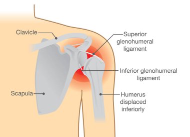 Dislocation Shoulder symptoms or separated.