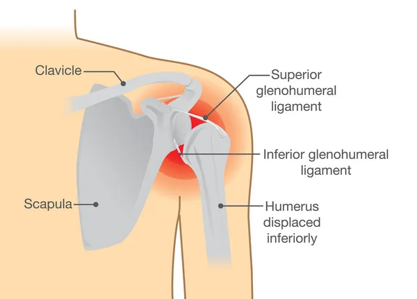 Dislocación Síntomas del hombro o separados . — Archivo Imágenes Vectoriales