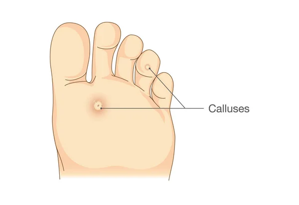 Piccoli cerchi pelle morta sul fondo di suole e dita dei piedi . — Vettoriale Stock