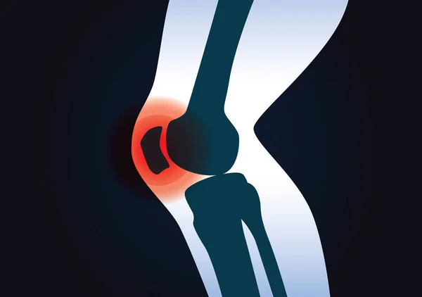 Κόκκινο σήμα στην περιοχή του γόνατος. — Διανυσματικό Αρχείο