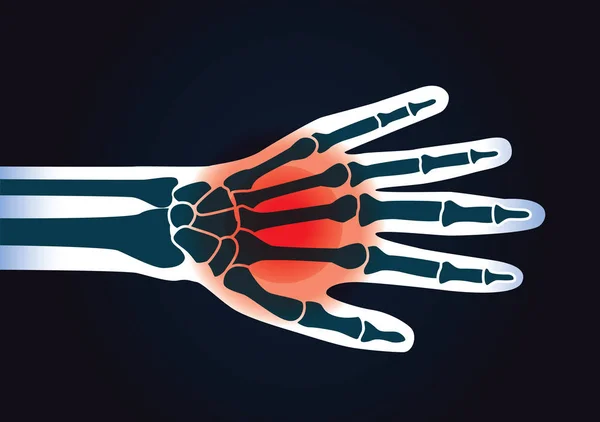 Οστών του ανθρώπινου χεριού έχει κόκκινο σήμα. — Διανυσματικό Αρχείο