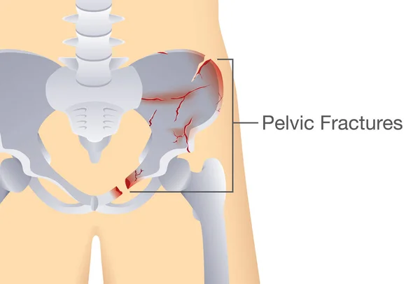 Fractures of the pelvic. — Stock Illustration Fractures of the pelvic. Vector Graphics