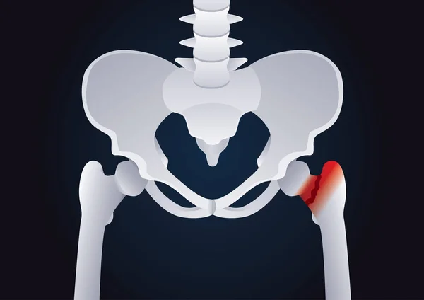 Dor óssea no quadril humano . — Vetor de Stock
