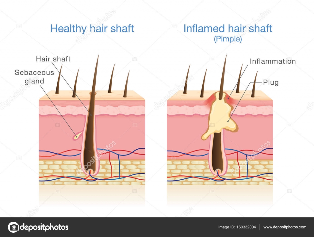 Infection In The Hair Follicles Stock Vector Image By C Solar22 Infection In The Hair Follicles Stock Vector Image By C Solar22