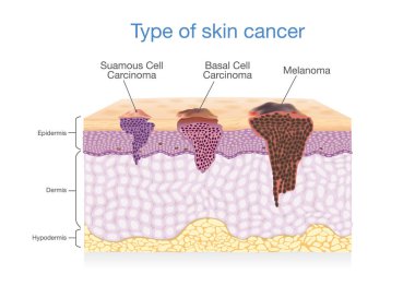 Skin layer have 3 Type of Cancer in one. clipart