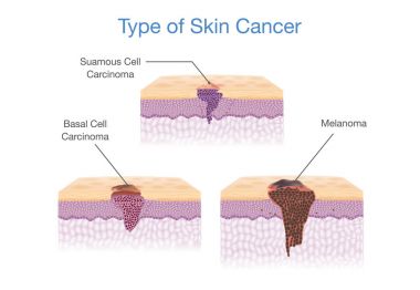 Type of Skin Cancer in 3D vector style. clipart