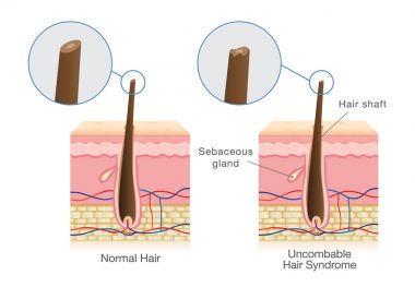 Difference of shaft of normal hair and uncombable hair syndrome. clipart