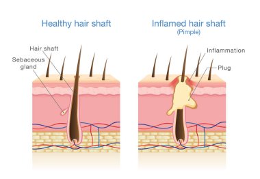 Infection in the hair follicles. clipart