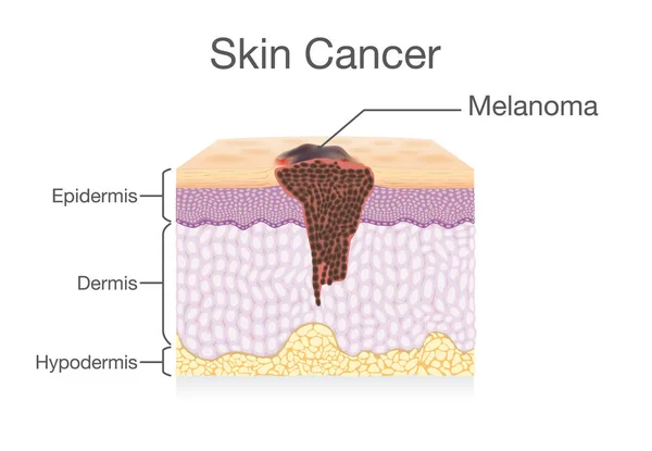 Épandage de cellules cancéreuses dans la couche de peau humaine . — Image vectorielle