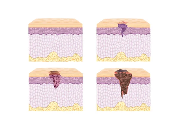 Couche de la peau normale et la propagation des cellules cancéreuses dans le style vectoriel . — Image vectorielle